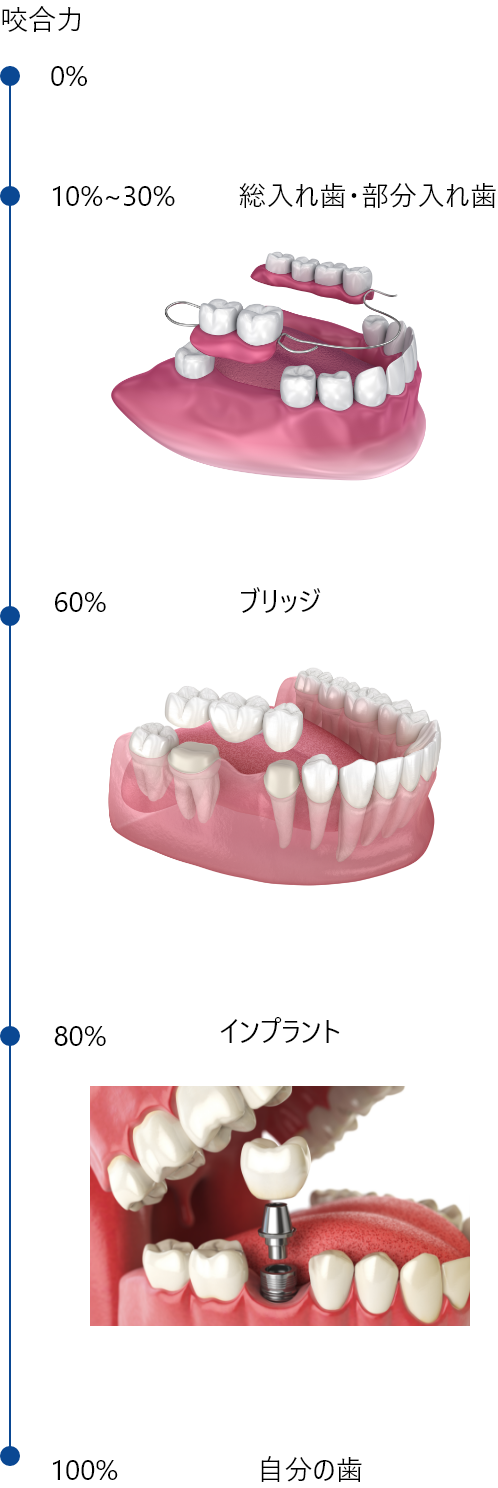 【咬合力】自分の歯：100％、インプラント：80～90％、ブリッジ：60％、総入れ歯・部分入れ歯：10～30％